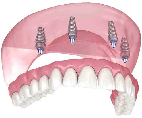 4 implant-supported denture