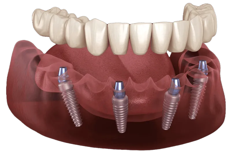 Permanent fixed zirconia teeth
