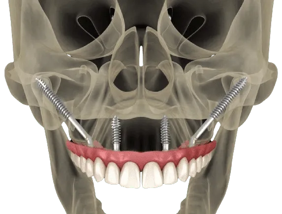 FP1 / zygomatic zirconia